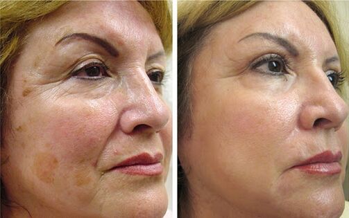 Anna from Wroclaw had a noticeable effect in smoothing wrinkles and tightening the contour of the face after using Canabilab