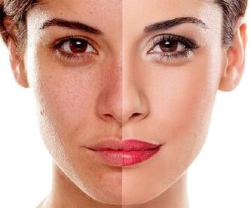 facial skin changes after a laser peel