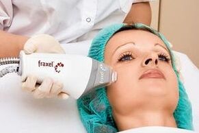 Fractional Laser Facial Skin Rejuvenation