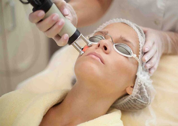 Laser skin rejuvenation procedure around the eyes