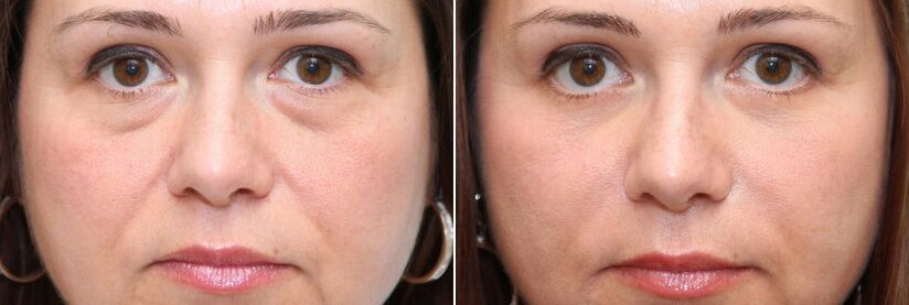 Before and after blepharoplasty - removal of fat under the eyes and firming of the skin