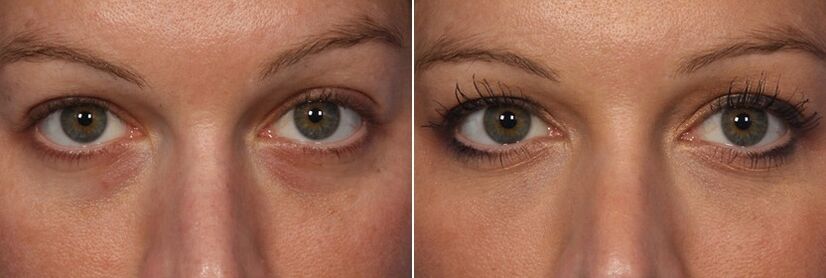 Before and after using injectable fillers - reduction of dark circles under the eyes